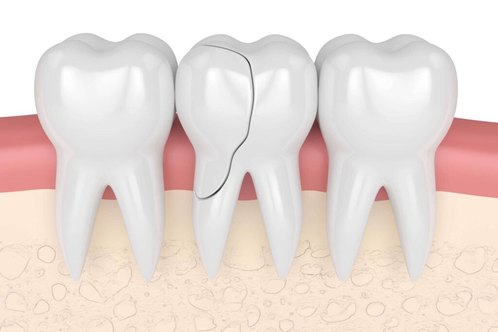 Cracked tooth treatment Redditch