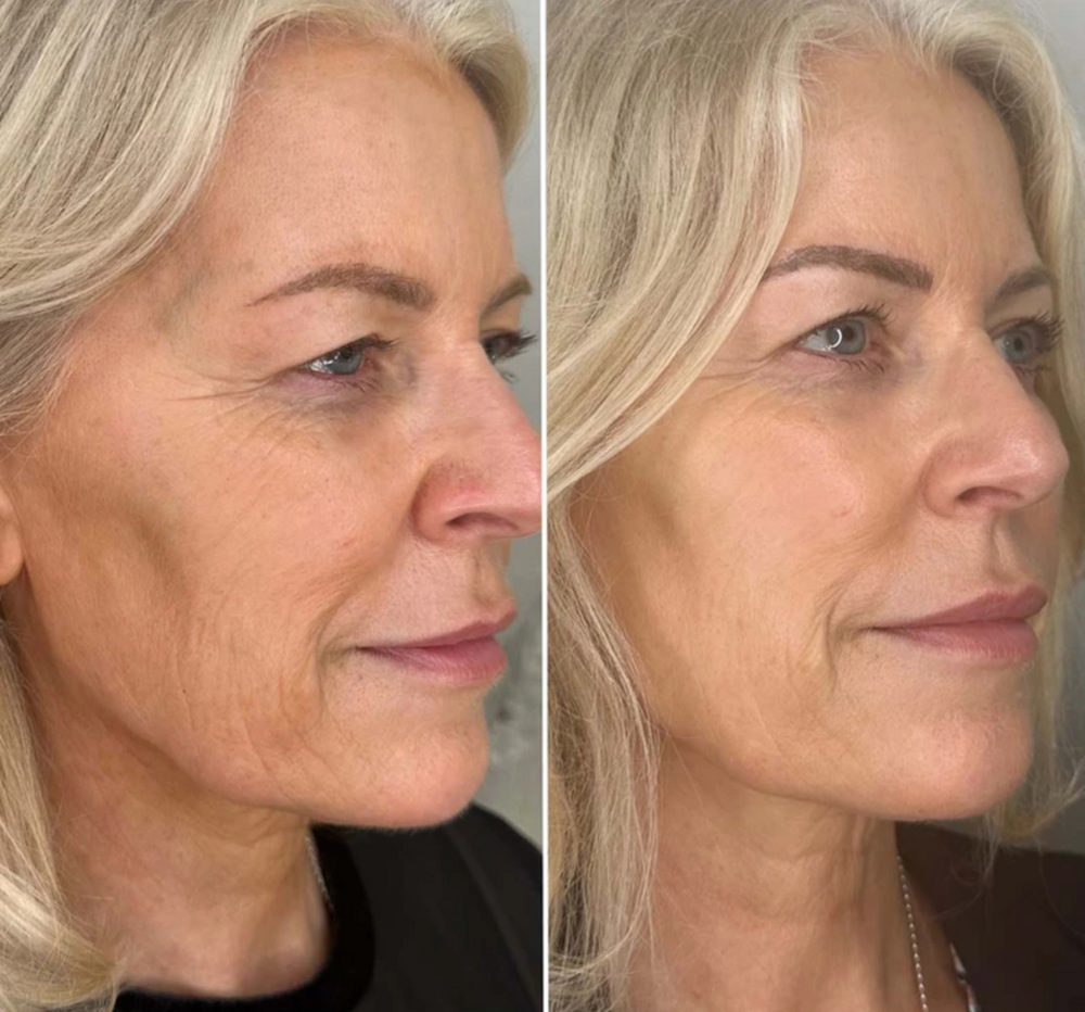 Polynucleotide treatment in Redditch