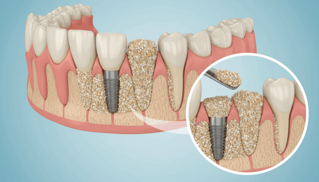 Dental bone graft in Redditch