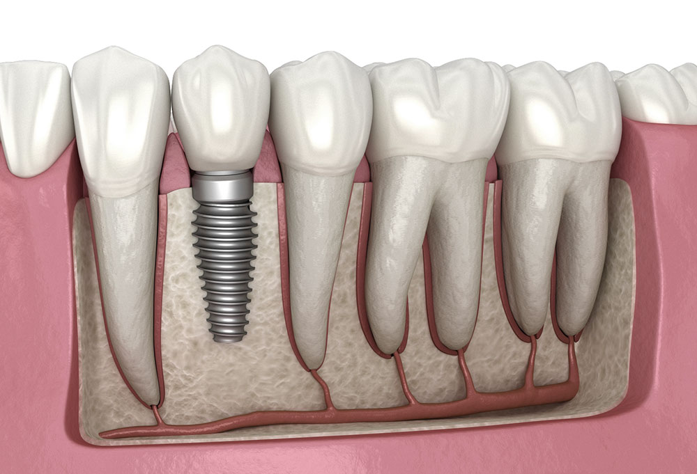 Dental Implants in Redditch