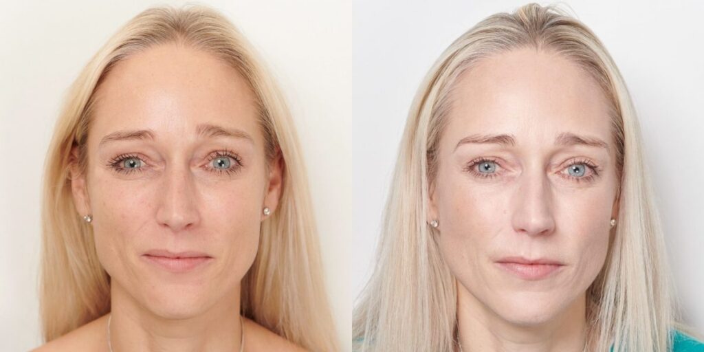 Profhilo treatment Redditch