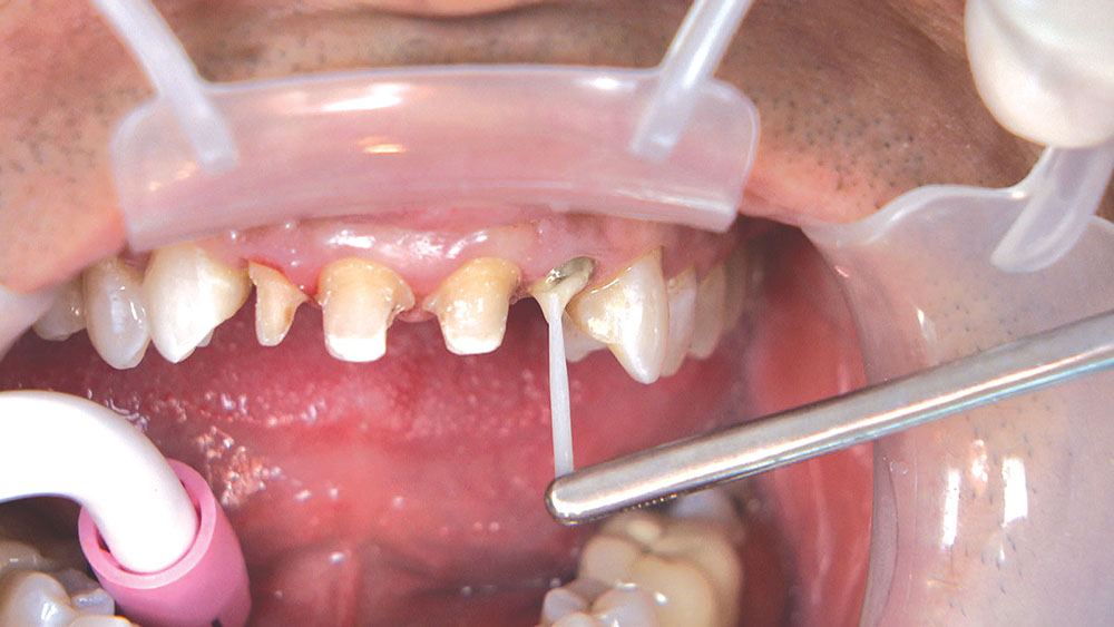 Post and core treatment in Redditch