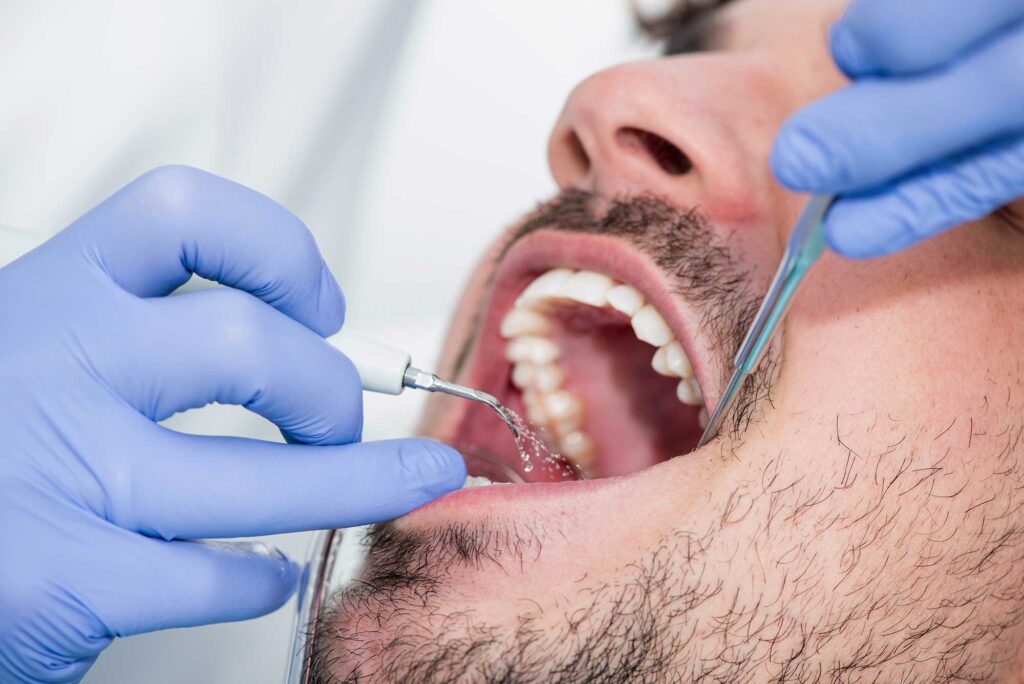 Periodontal maintenance in Redditch