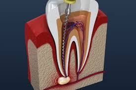 Root Canal Treatment in Redditch