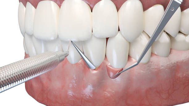 Periodontal maintenance in Redditch