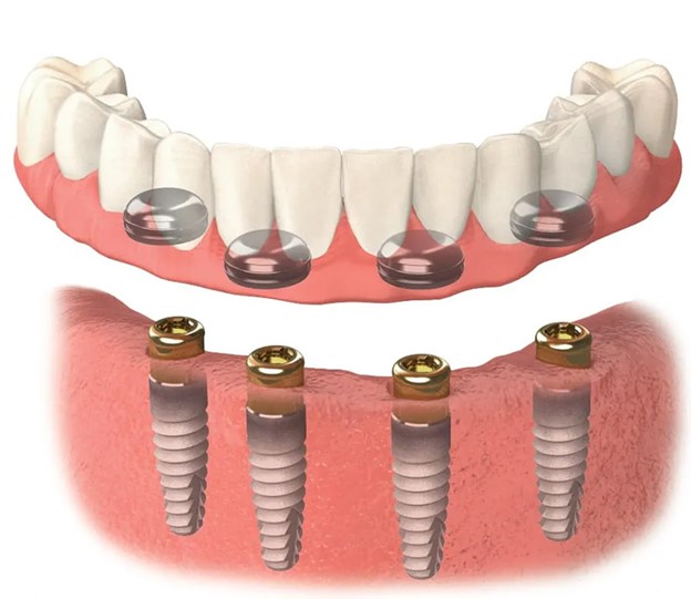 Implant retained dentures in Redditch