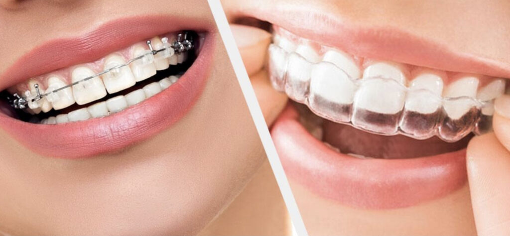 Orthodontic treatment Redditch