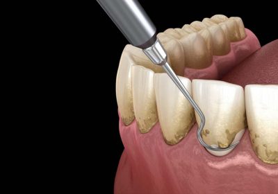 Periodontal-Treatment