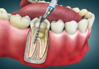 kanal-tedavisi-hakkinda-her-sey