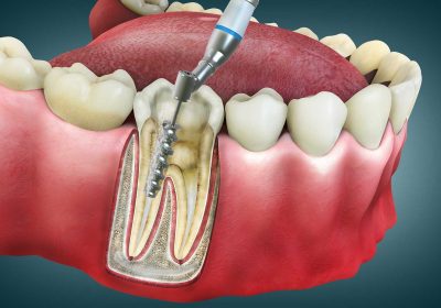 kanal-tedavisi-hakkinda-her-sey