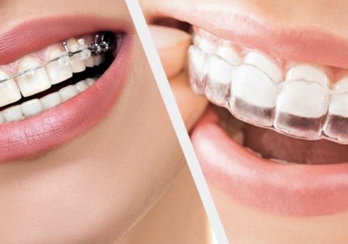 Orthodontic treatment Redditch